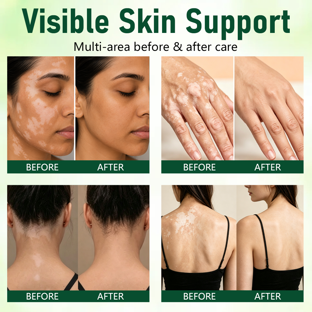 QIAWI® Herbal Vitiligo Cream