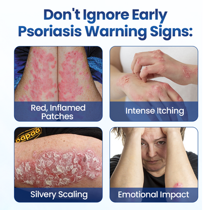 QIAWI® PsoriaMucin No-Rub Itch & Flake Relief Mist