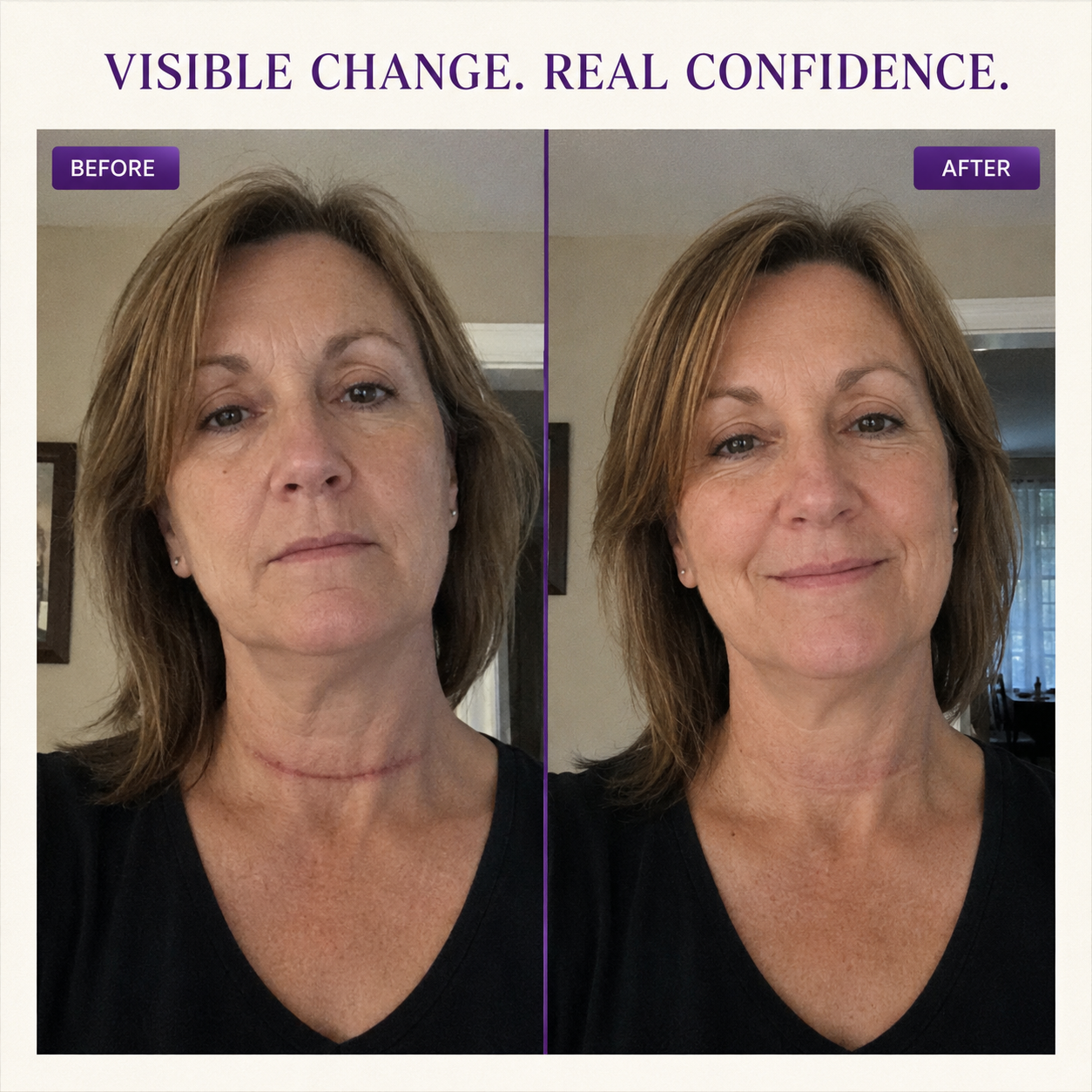 Genuinegyre® Allantoin Scar Gel- limited-time discount